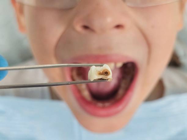 Best Emergency Tooth Extraction in Rmel By The Sea, CA